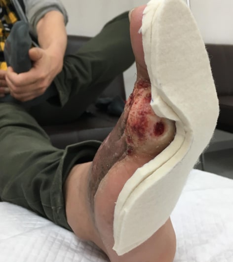 医療用フェルトを用いた患部免荷画像