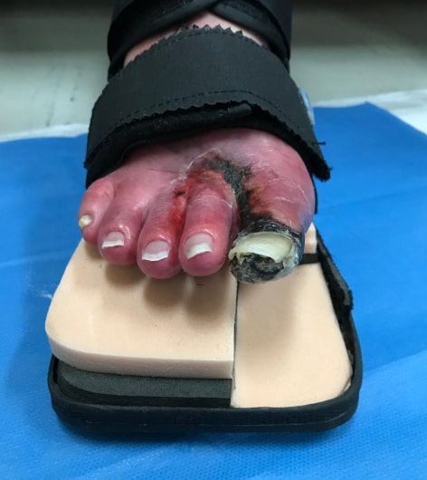 ダルコサンダルを用いた前足部の免荷画像