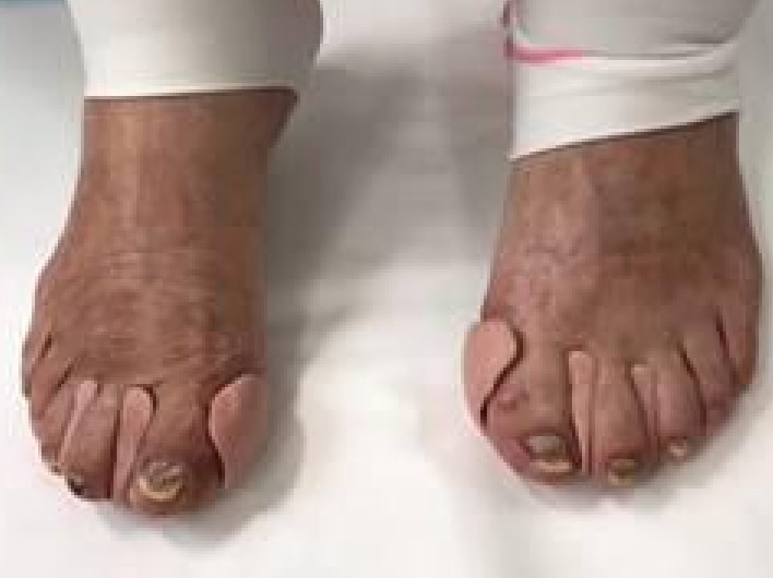 趾間パッド／趾まくら画像